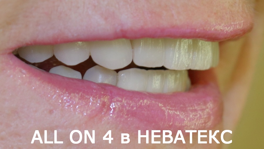 челюсть на 4 имплантах до и после