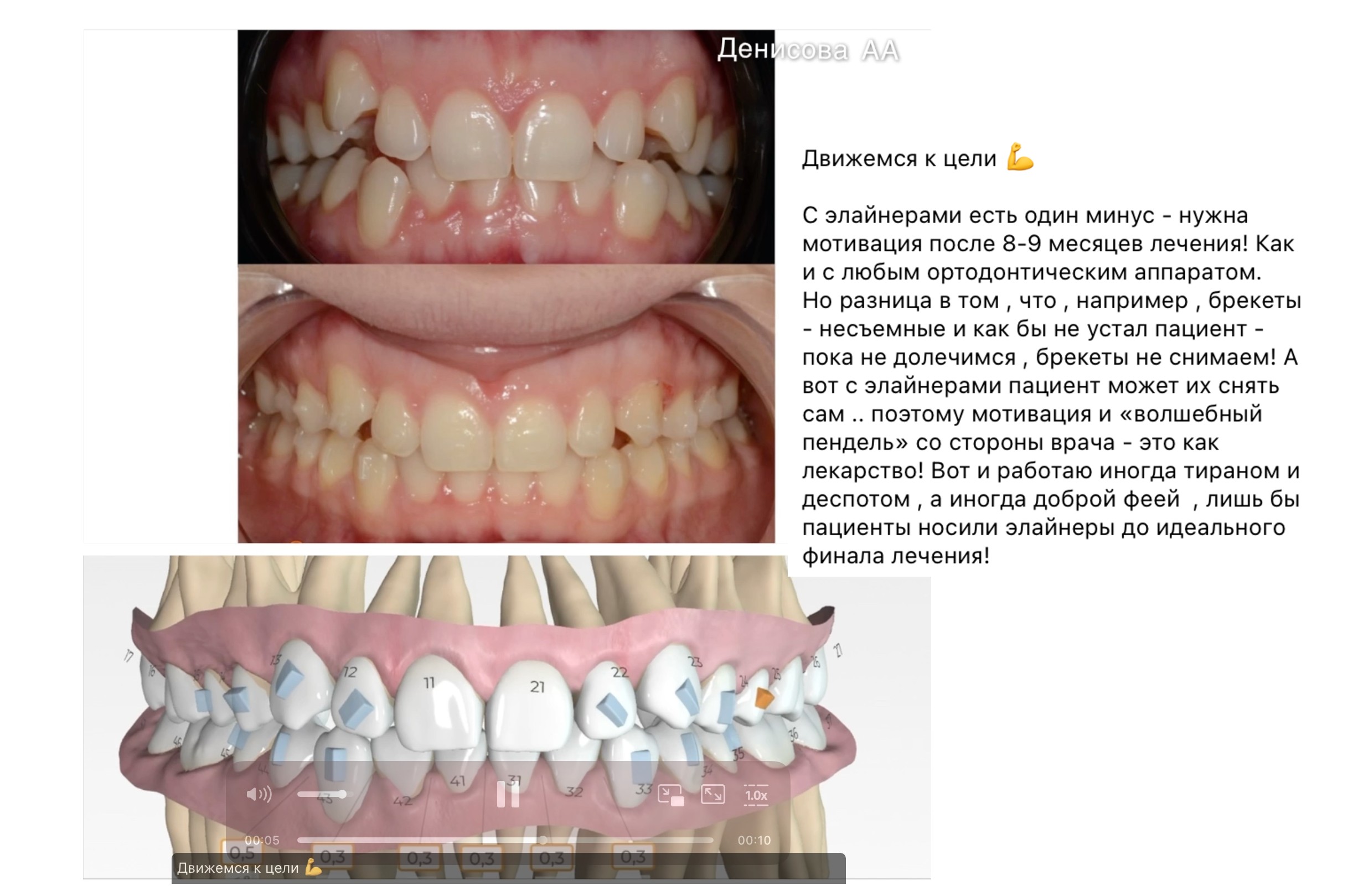 улыбка до и после-13