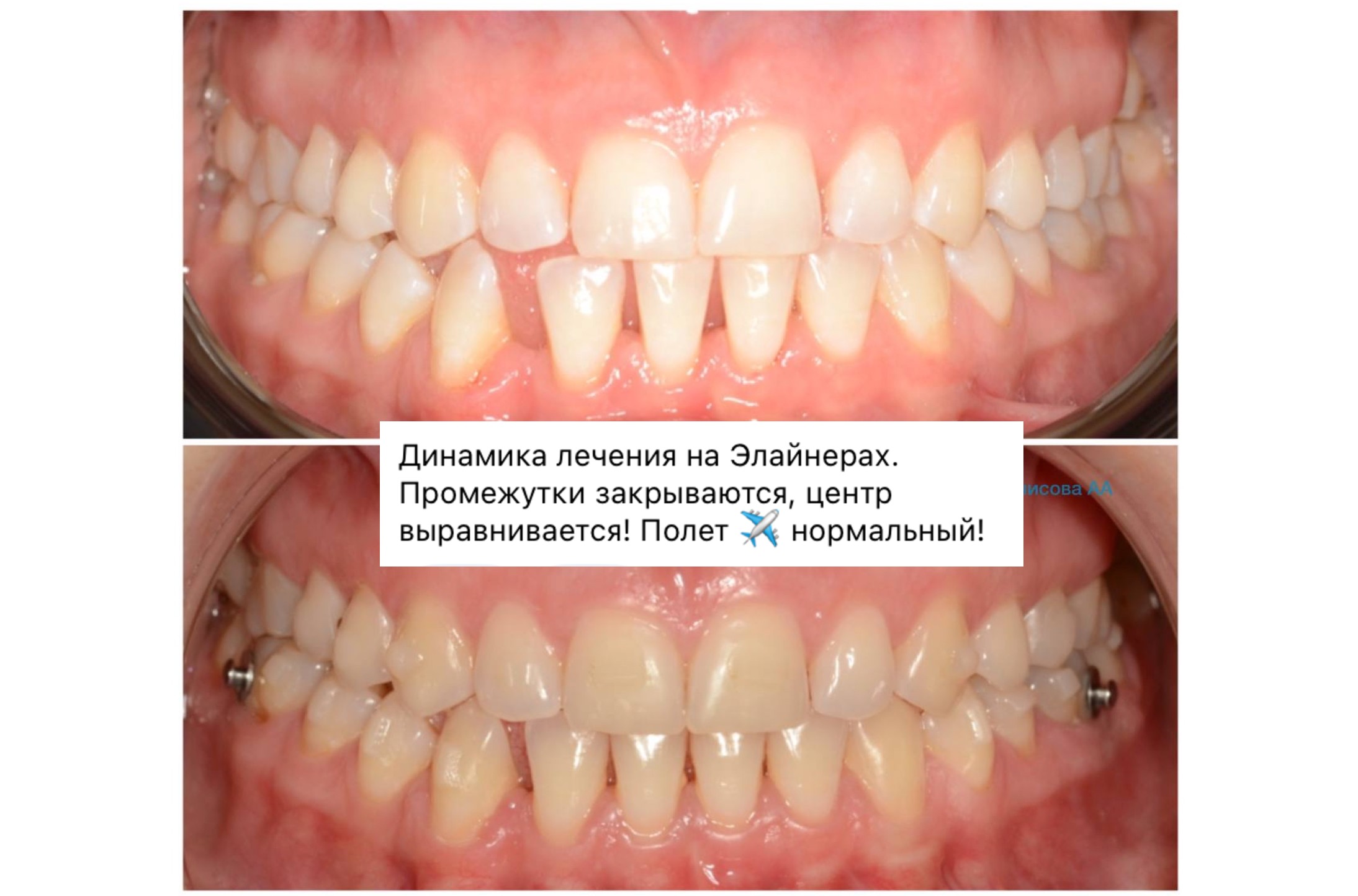 улыбка до и после-16