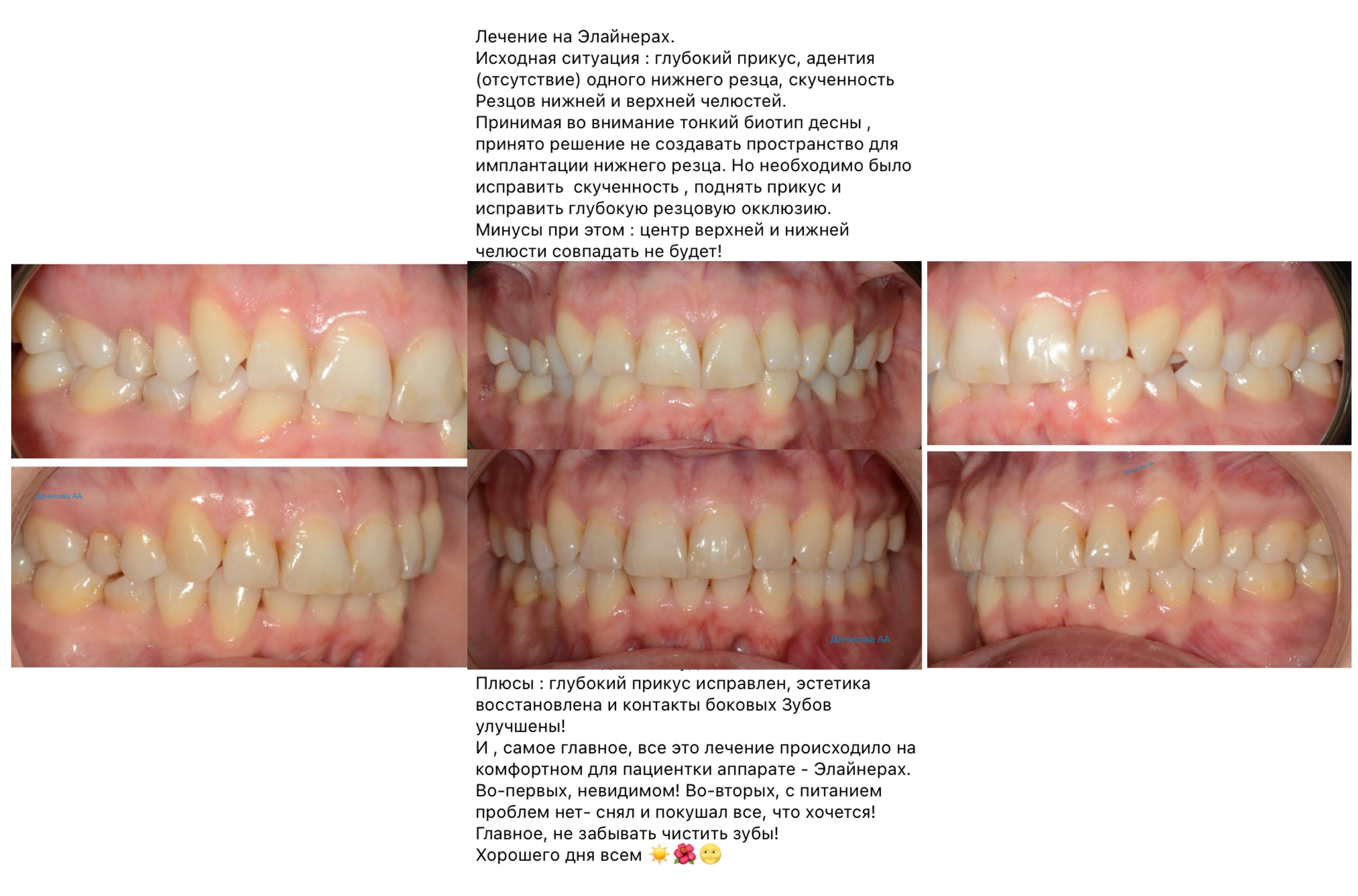 улыбка до и после-17