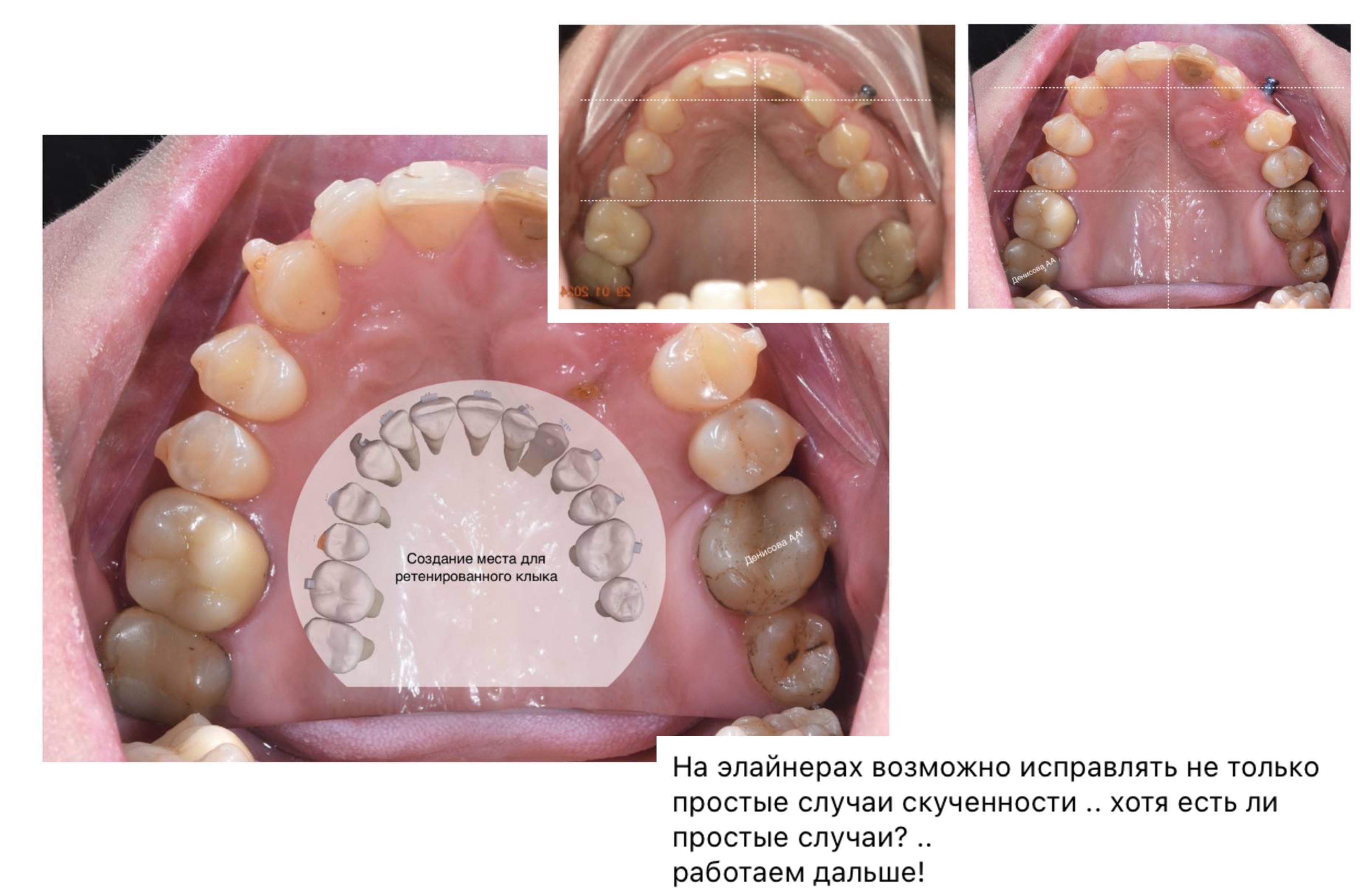 улыбка до и после-2