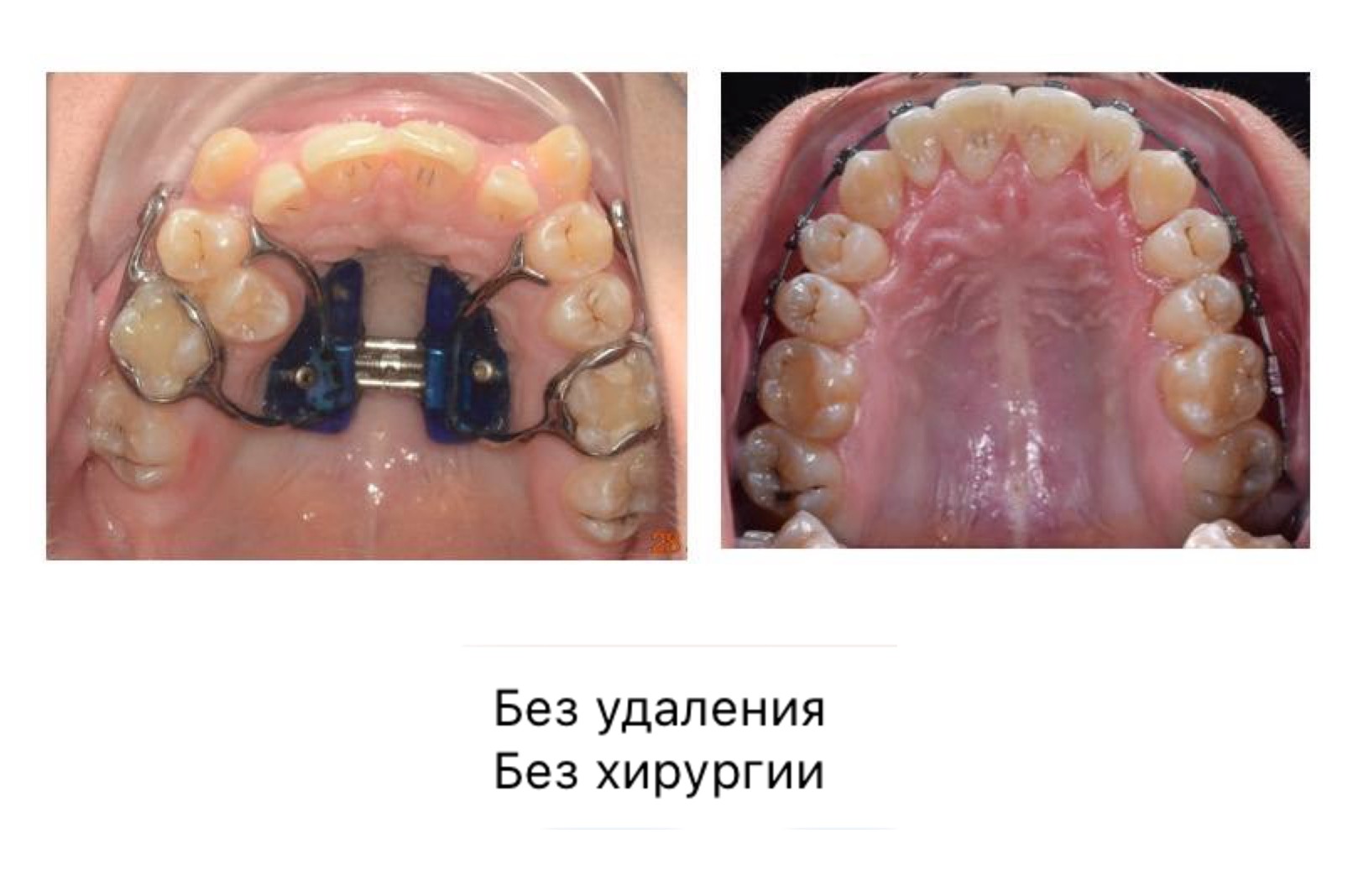 улыбка до и после-4