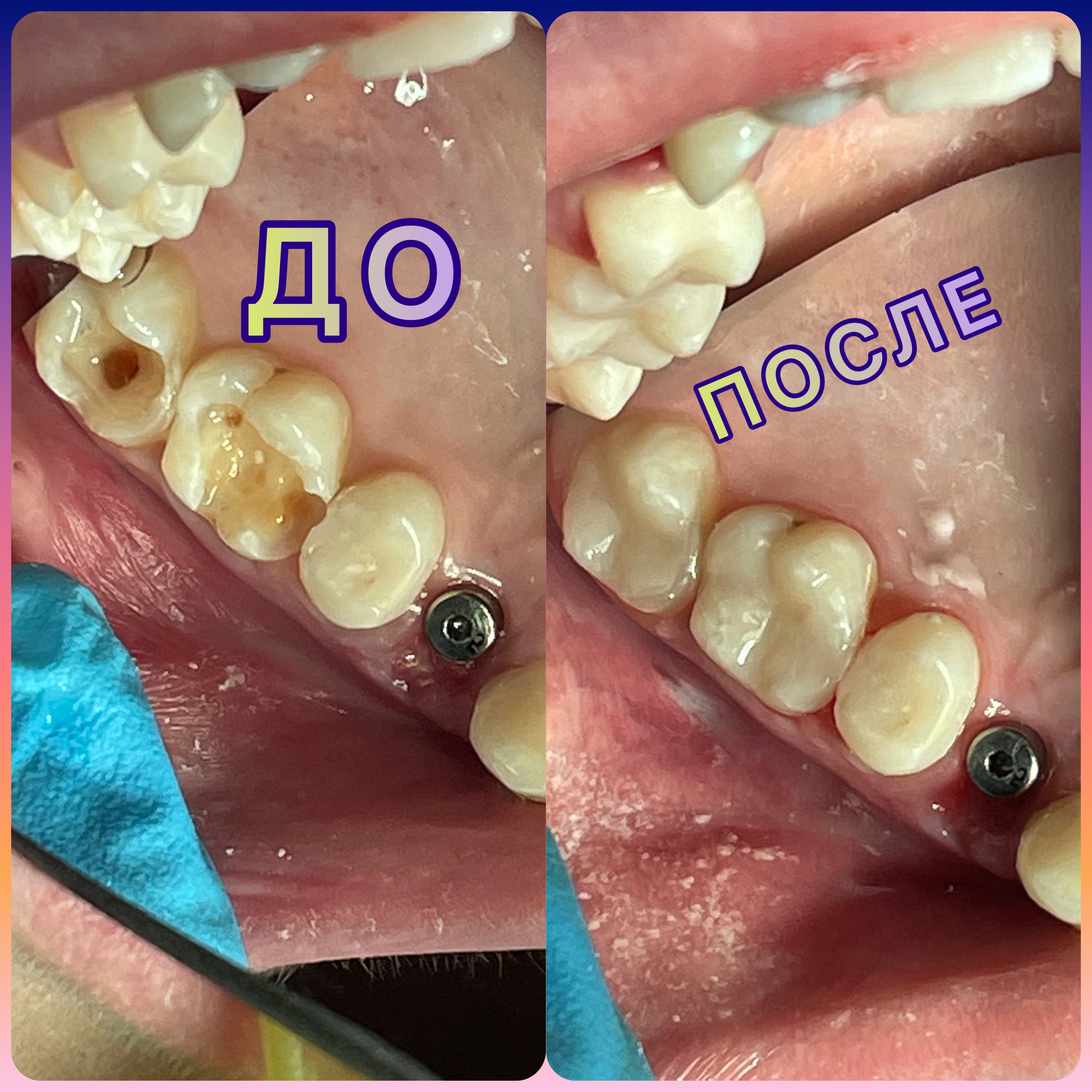 Фото до и после лечения зубов