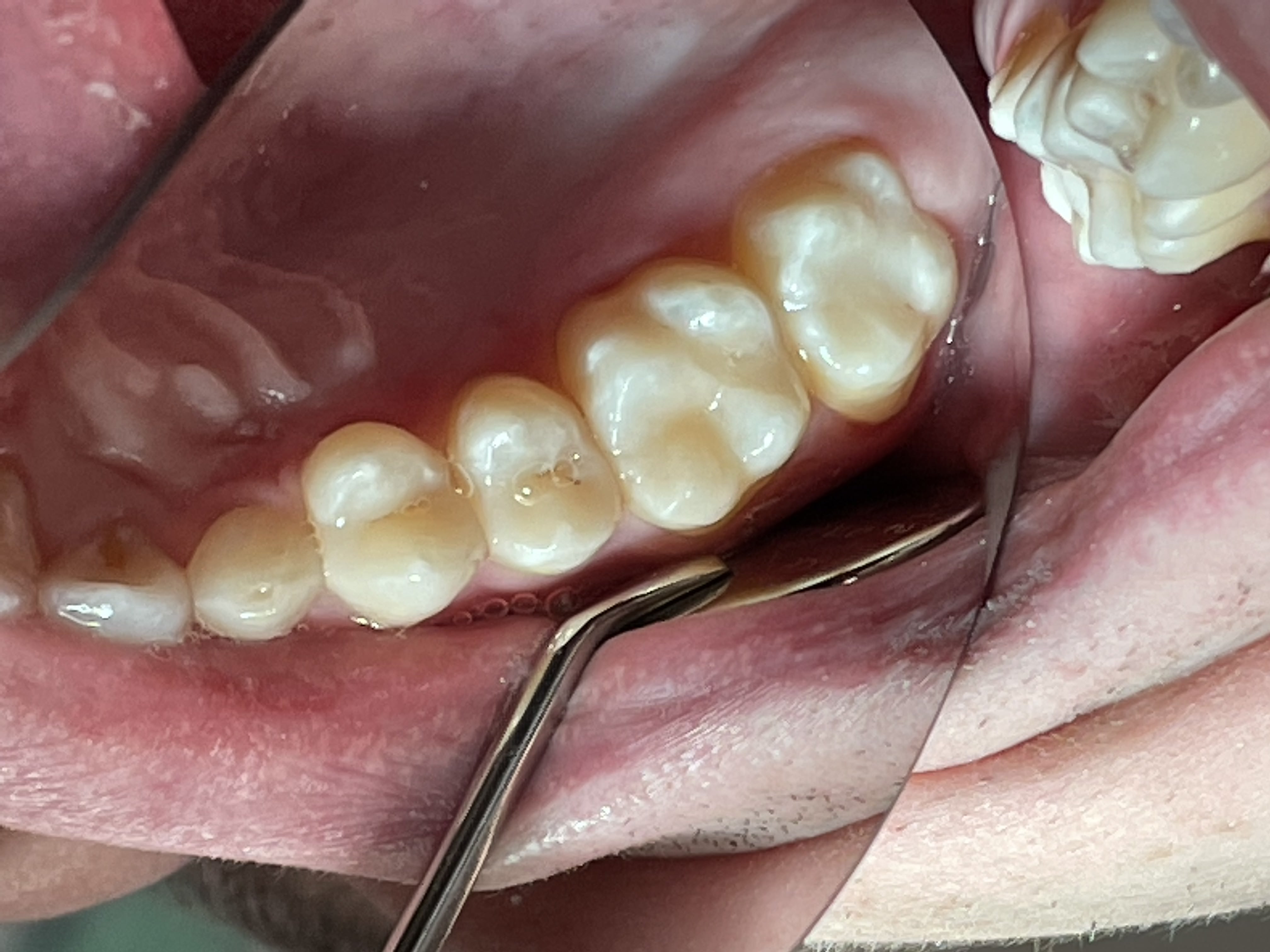 Результат лечения зубов в Неватекс