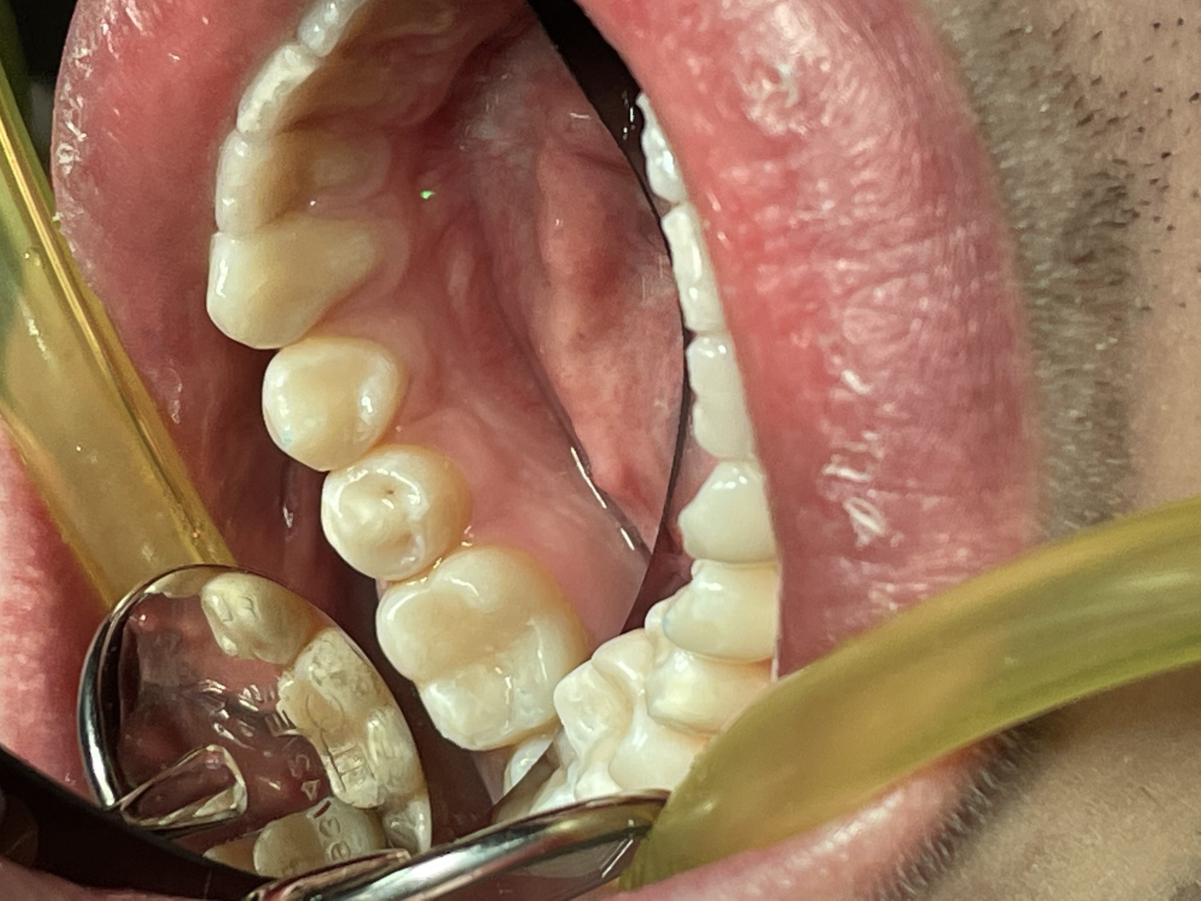 Результат лечения зубов в Неватекс